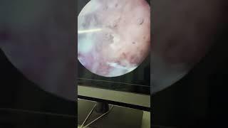 Hystroscopic removal of reminants of conception by Waleed almery