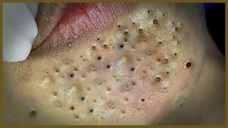 Blackhead Removal | Blackhead extraction | #blackheads