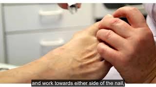 Toenail care for blister prevention
