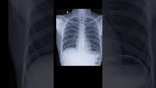 Normal & abnormal chest x ray #xray #shortvideo #youtubeshorts #viral #medical #medicalprofessionals