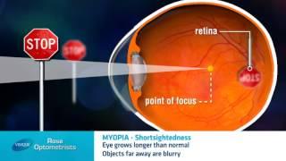 Short-sightedness - What is it? -  Rose Optometrists explain