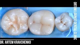 Прямые реставрации, восстановление окклюзионных поверхностей Ortom lounge dental clinic