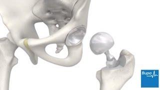 How a hip replacement is carried out | Bupa Health