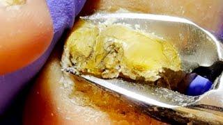 Onychomycosis caused by nail infection![Doctor Liu Pedicure]