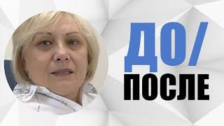 #5 Случай до/после. Имплантация зубов. Врач Гранцев Михаил Михайлович