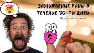 Заживление раны в течение 30-ти дней (Не для слабонервных)