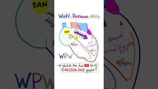 Cardiac Arrhythmia- Wolff-Parkinson White (WPW) Syndrome.. #science #cardio #nurse #doctor #mbbs