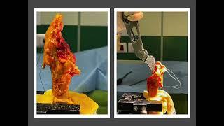 Proximal femur reconstruction with a cemented allograft-prosthesis composite