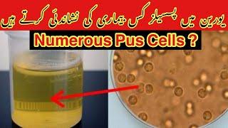 Numerous Pus Cells In Urine Urdu/hindi |What causes numerous pus cells in urine? Numerous Leukocytes