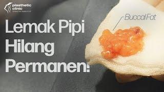 Honest Review‼️ Operasi Pipi Tirus di Plasthetic Clinic I Buccal Fat Removal