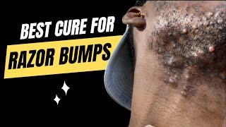 BEST CURE FOR RAZOR BUMPS | Barber Luther King