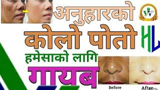 अनुहार को कालो दाग लाई बाइ बाइ / Vestige Products for pigments, black spot & dark circle/Kalo Poto