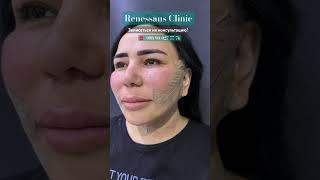 Dr.Sanjar Sharopov #facelifting #renessansclinic