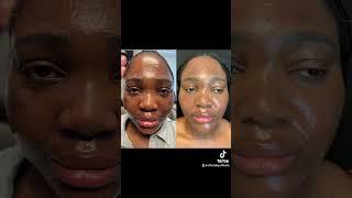 #Moxi On DARK SKIN! Choose Your Laser Center carefully #dmvlaser #bolusmedspa #maryland #beauty