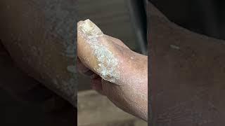 Calluses #feet #podiatry #footcare #callus #callusremoval