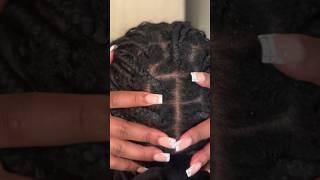 What is SEBORRHEIC DERMATITIS & how am I LIVING with it? (Part 2)
