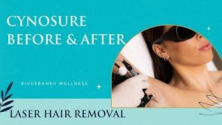 Cynosure Laser Hair Removal: Before & After | What You Need to Know