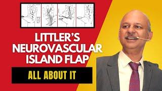 Littler's Neurovascular Island Flap for Thumb reconstruction - Surgical technique - Tips and tricks