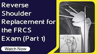 Reverse Shoulder Arthroplasty for FRCS Ortho Exam | Biomechanics | Orthopaedic Academy