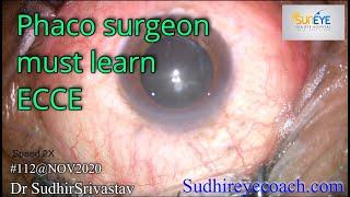 Extra-Capsular Cataract Surgery(ECCE) -Dr Sudhir Srivastava