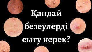 БЕЗЕУДЕН ҚҰТЫЛУ ЖОЛДАРЫ. БЕЗЕУ ТУРАЛЫ МӘЛІМЕТТЕР. УГРИ. АКНЕ. ACNE.