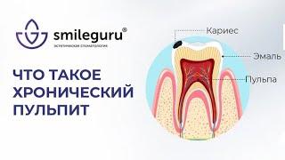 Хронический пульпит - что это и чем опасен?