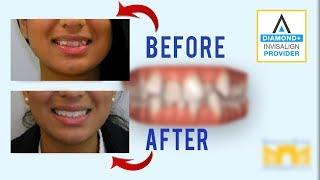 Invisalign Before and After: Crowded Teeth