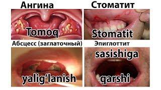 !!! УЙДА СТОМАТИТ ОГИЗДАГИ ХИДЛАНИШ  ЯЛЛИГЛАНИШНИ  ТЕЗ ВА ОСОН ДАВОЛАШ