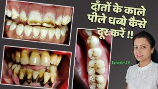 black spots on teeth how to remove home remedies | दांतों की सफाई Episode 28