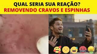 Espremendo cravos e espinhas relaxantes Cravos e Espinhas GIGANTES