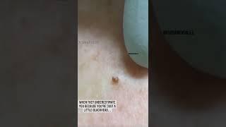 Small BUT Mighty Blackhead | Dr. Pimple Popper #shorts #youtubeshorts #pimple #blackhead #popping