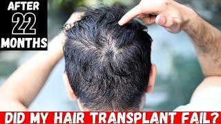 my hair transplant result outdoor | Born Creator clips