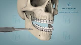 Cirurgia Ortognática em 3D - Renato Marano