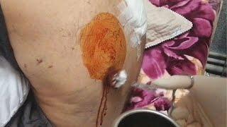 Lung fluid aspiration | Thoracentesis | Pleural tap procedure