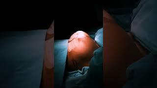 Breast Implant Reels