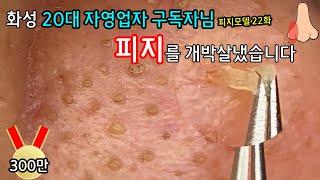 피지 직접 뽑아드렸습니다 _ 피지제거 블랙헤드제거 피지뽑기 _  22번째 모델이신 화성 자영업자 대표 20대 남자분의 피지를 박살냈습니다