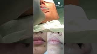 Mole Removal Transformation!  Before & After Results | Safe & Effective Treatment in Delhi