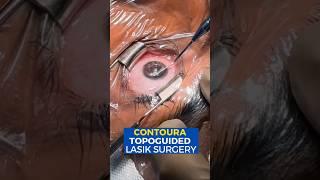 Live Contoura Topo-guided Lasik Surgery