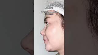 The Power of Tip Plasty!