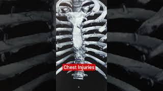 Chest Injuries.. Dr Sai Chandra MBBS DNB Ortho Hyderabad