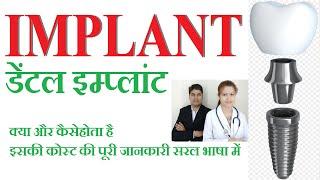 डेंटल इम्प्लांट ।क्या है । कैसे होता है ।खर्चा समझें हिंदी में । Dental Ipmlant details in Hindi ।