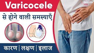 Varicocele से होने वाली समस्याएँ और इलाज | #Varicocele Symptoms, Causes And Treatment in Hindi