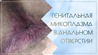  Генитальная микоплазма в анальном отверстии. Клинический случай №64