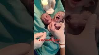 Conjoned twins viral #twinsbaby #twins #conjoinedtwins #conjoint #youtubeshorts #shorts #viralshorts