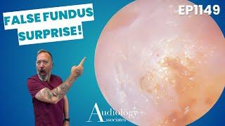 Hard Wax Plugs & Satisfying Skin Peel | Microsuction Ear Wax Removal - EP1149