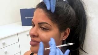 Botox Cosmetic Treatment for Wrinkle, Before and After