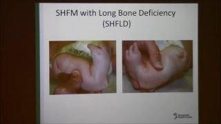 Dr. David Everman - Split hand/foot Malformation