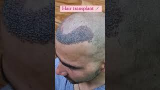 Amazing Hair Transplant Journey | Hair Transplant Result Before After dr Shahid Mirza #shorts #viral