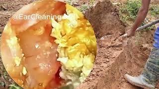 So Terrifying: Infected, Stinky, Dry Ear Wax Removal | ASMR | EP 43