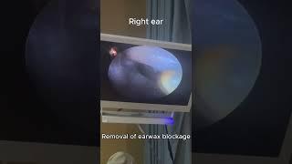 Removal of earwax blockage#asmr #Visual ear cleaning